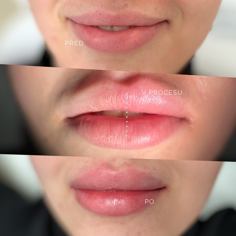 Zvětšení rtů