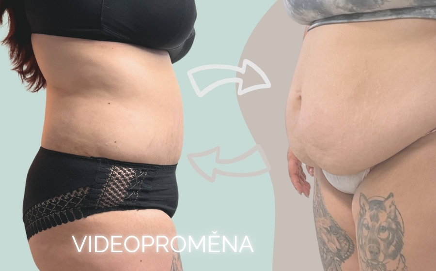 ABDOMINOPLASTIKA, CBP KLINIKA, ABDOMINOPLASTIKA BRNO, ABDOMINOPLASTIKA JIHLAVA