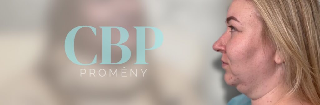 CBP Klinika, Liposukce podbradku