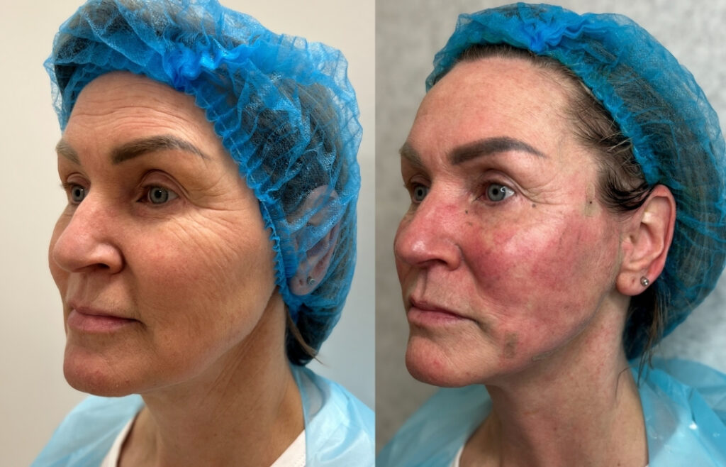 Niťový lifting Aptos