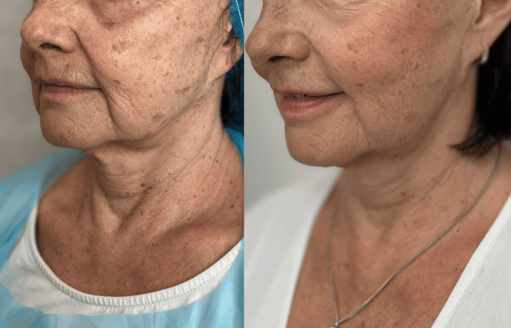Před a po niťovém liftingu – zvednutí tváří a zpevnění kontur obličeje